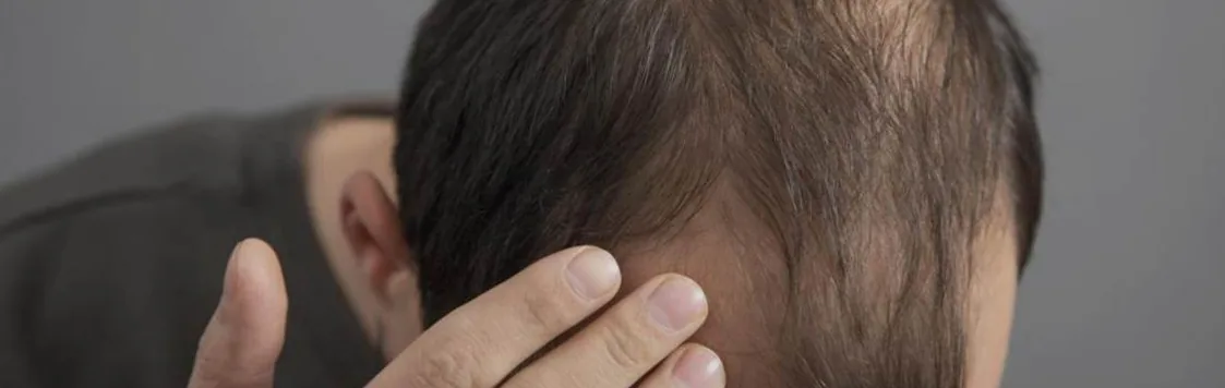A man holding the side of his head where his hair is thinning